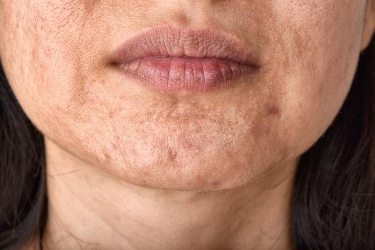 Acne scar revision