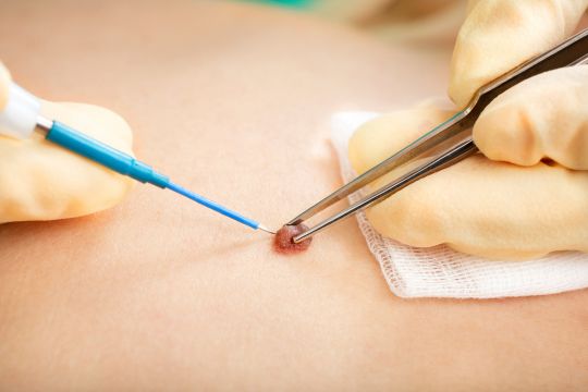 Mole removal
