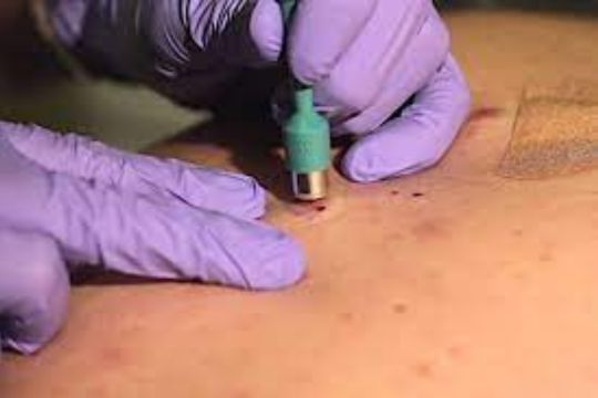 Skin biopsy