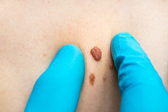Skin tag removal