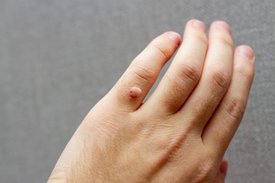 Wart removal